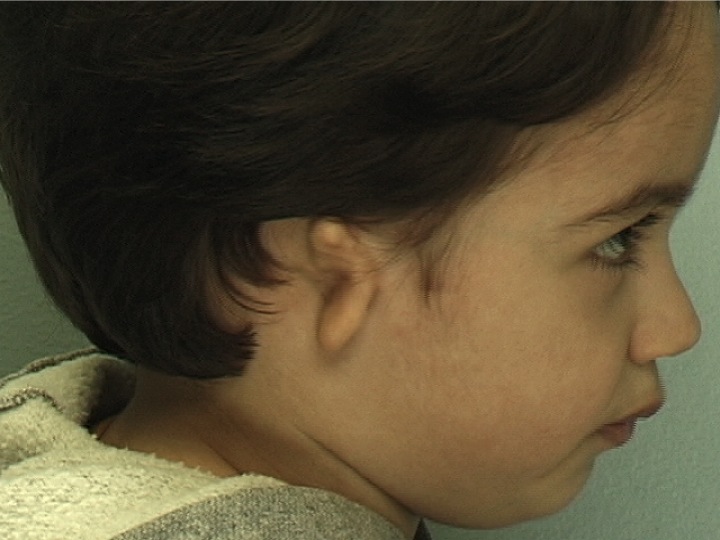 Patient 1 - Before Surgery