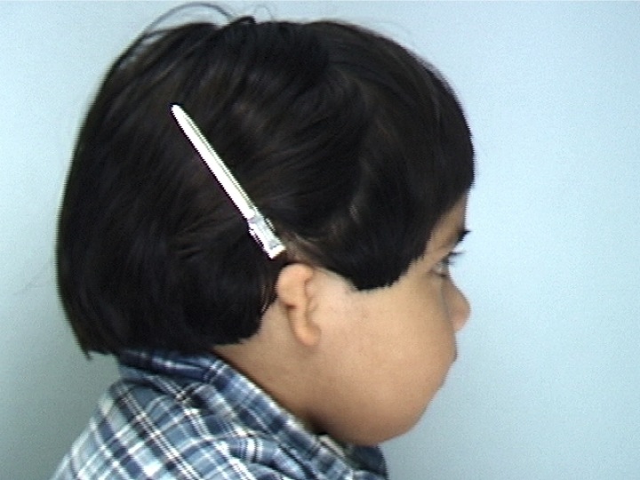 Patient 2 - Before Surgery