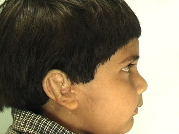 Patient 2 - After Surgery